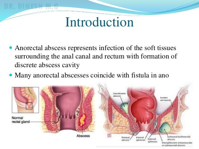 Happiness! Anal abscess infection amusing Sorry, that Anal abscess infection